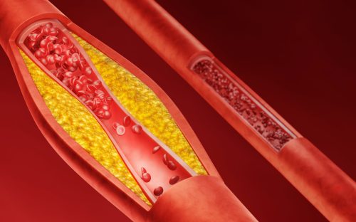 Hyperlipidemia,Or,Arteriosclerosis.,Blocked,Artery,Concept,And,Human,Blood,Vessel